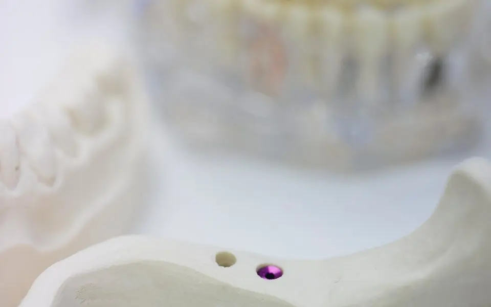 Kiefermodell mit Implantat zur Erklärung der Behandlung
