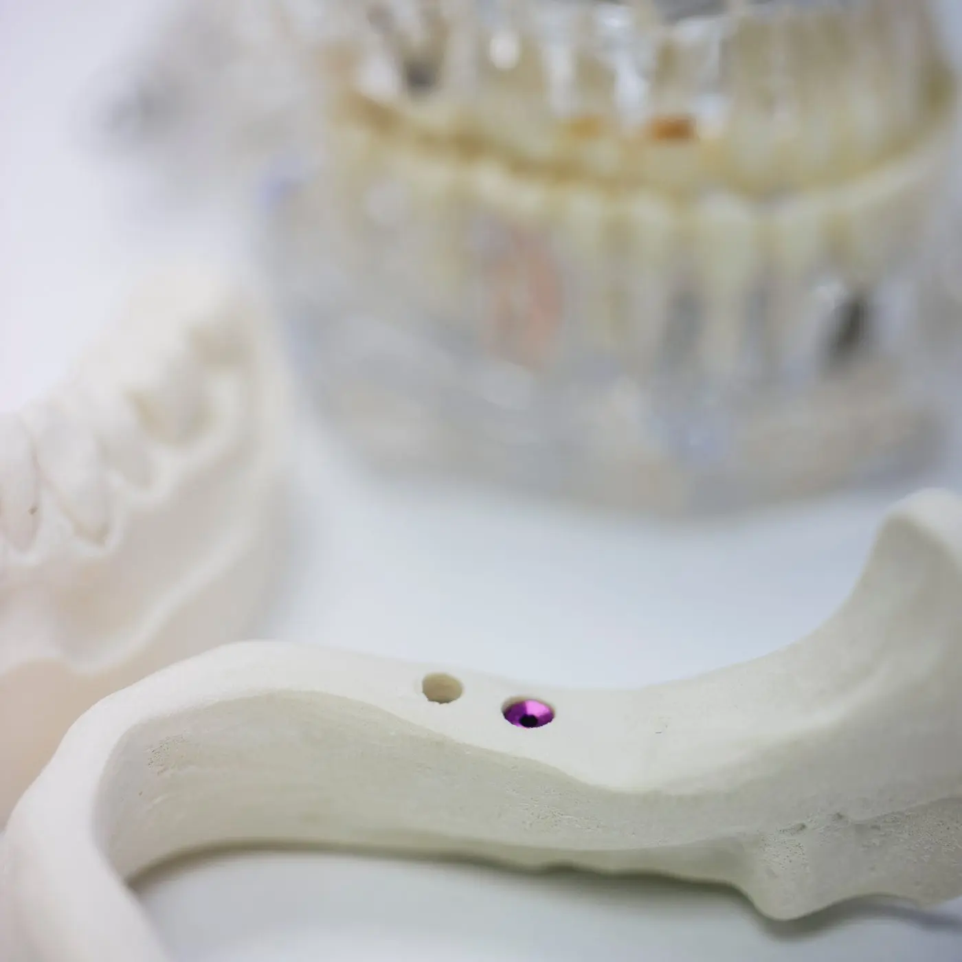 Kiefermodell mit Implantat zur Erklärung der Behandlung